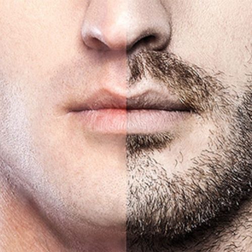 Beard Transplant Cost Turkey