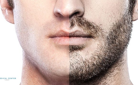 Beard Transplant Cost Turkey