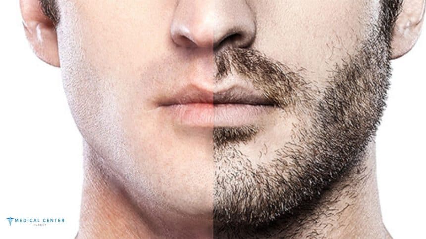 Beard Transplant Cost Turkey Beard Transplant Cost Turkey