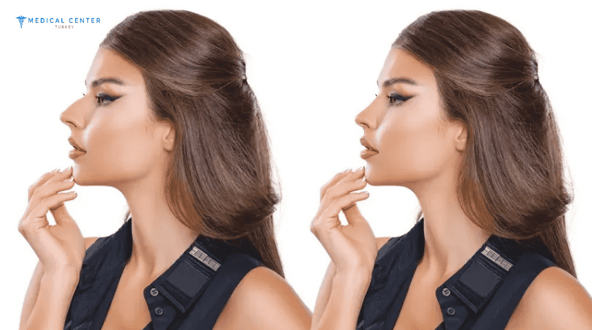 Is Turkey the Best Destination for Rhinoplasty? Is Turkey the Best Destination for Rhinoplasty?