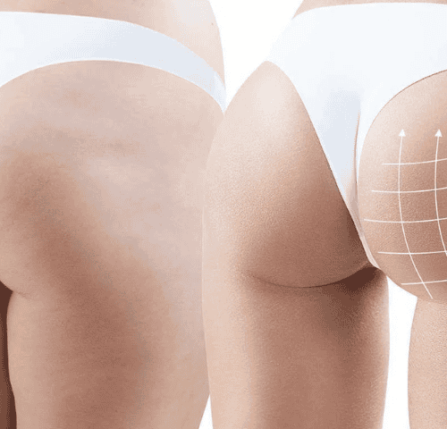 Brazilian Butt Lift in Turkey