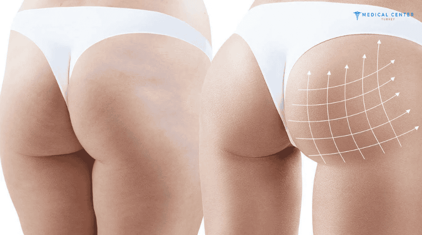 Brazilian Butt Lift in Turkey