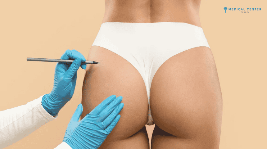 BBL in Turkey BBL in Turkey