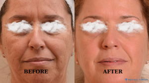 Advances in Laser Skin Resurfacing Techniques in Turkey 2025