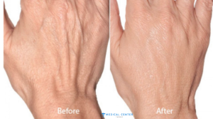 Rejuvenating Hand Treatments: Anti-Aging Solutions for Your Hands in Turkey