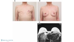 Understanding the Process of Breast Reconstruction After Mastectomy in Turkey