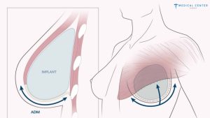 Understanding the Process of Breast Reconstruction After Mastectomy in Turkey