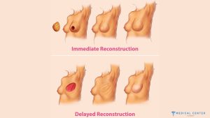Understanding the Process of Breast Reconstruction After Mastectomy in Turkey