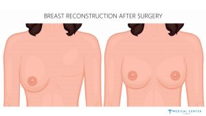 Understanding the Process of Breast Reconstruction After Mastectomy in Turkey