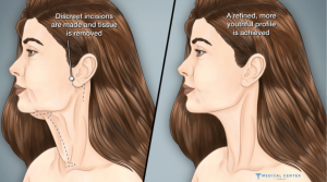 A 2025 Solution for a Youthful Neckline