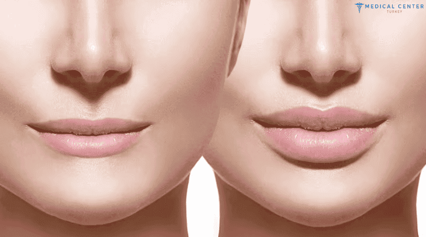 Achieving Fuller Lips with Natural Lip Fillers in Turkey