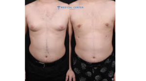Gynecomastia in Turkey at a Glance 