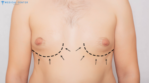 Gynecomastia in Turkey at a Glance 