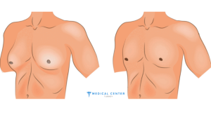 Gynecomastia in Turkey at a Glance 