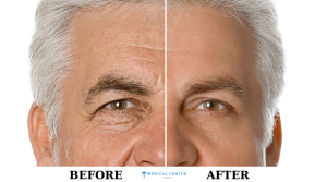 Forehead Lift Surgery in Turkey 2025