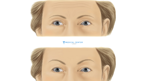 Forehead Lift Surgery in Turkey 2025