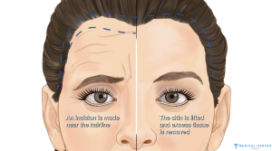 Forehead Lift Surgery in Turkey 2025