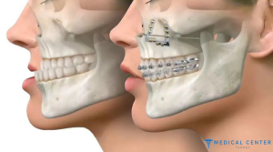 How Much Does Jaw Surgery Cost in Turkey 