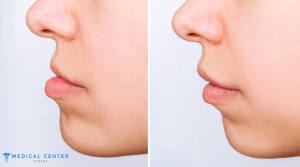 How Much Does Jaw Surgery Cost in Turkey 