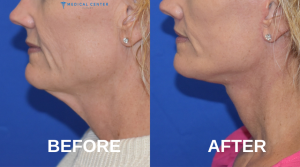 How much does a Neck Lift cost in Turkey 2025?
