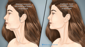 How much does a Neck Lift cost in Turkey 2025?