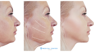 How much does a Neck Lift cost in Turkey 2025?