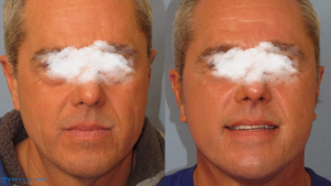 The Rise of Male Cosmetic Procedures: What's Popular in Turkey?