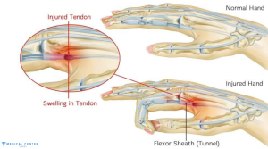 Trigger Finger Correction in Turkey 2025