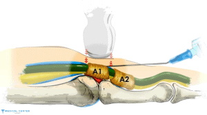 Trigger Finger Correction in Turkey 2025