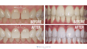 Cost of Dental Whitening for a Brighter Smile in Turkey 2025