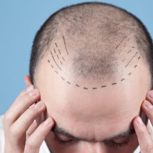 Is Turkey the Best Destination for Hair Transplants? Is Turkey the Best Destination for Hair Transplants?