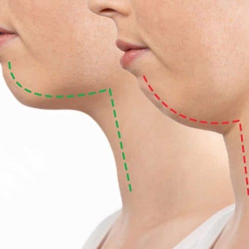 How Much Does Jaw Surgery Cost in Turkey? How Much Does Jaw Surgery Cost in Turkey?