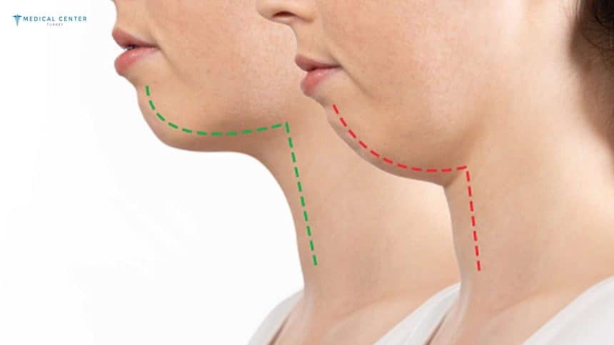 How Much Does Jaw Surgery Cost in Turkey?