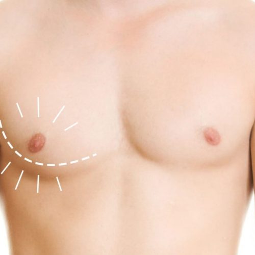 Gynecomastia in Turkey at a Glance Gynecomastia in Turkey at a Glance