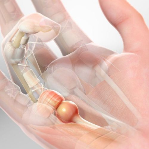 Trigger Finger Correction in Turkey Trigger Finger Correction in Turkey