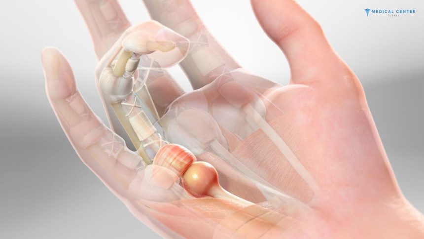 Trigger Finger Correction in Turkey