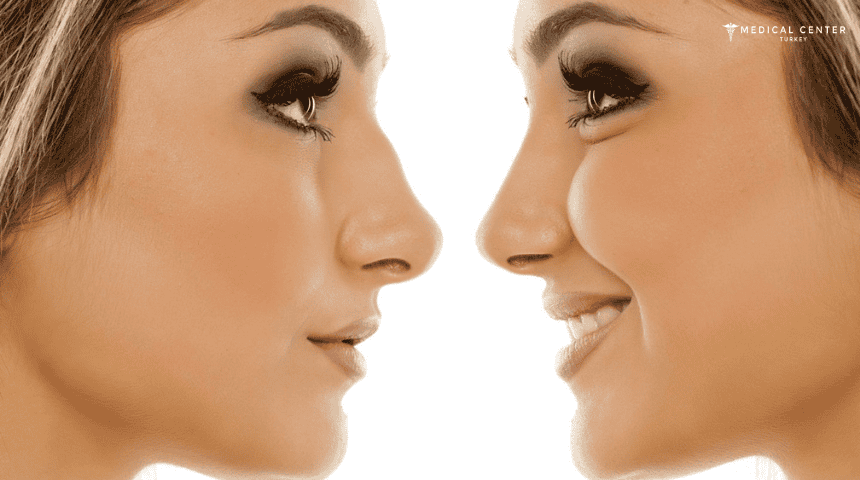 The Benefits of Non-Invasive Rhinoplasty in 2025