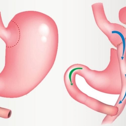 Are you Eligible for Gastric Bypass Surgery in Turkey? Are you Eligible for Gastric Bypass Surgery in Turkey?