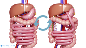 Are You Eligible for Gastric Bypass Surgery?