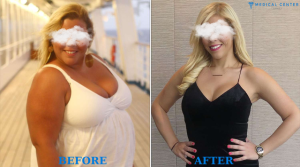 Are You Eligible for Gastric Bypass Surgery?