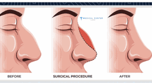 Nose Job Guide in Turkey 