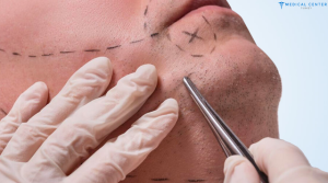 Beard Transplant in Turkey: Lower Cost, Top Care