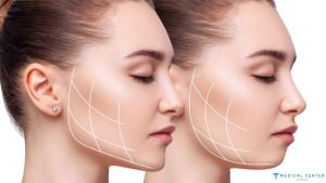 Bichectomia 2025 What You Need to Know About Facial Sculpting