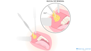 Bichectomia 2025 What You Need to Know About Facial Sculpting