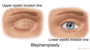 Eye Lift in 2025 Say Goodbye to Droopy Eyelids