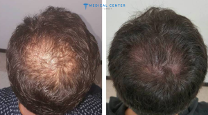 Hair Transplantation in Turkey Types, Prices, Procedures