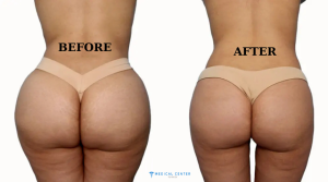 How a Butt Lift Can Boost Your Confidence in 2025