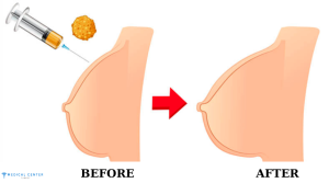 Is Breast Augmentation Still a Popular Choice for 2025?