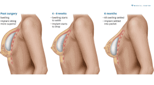 Is Breast Augmentation Still a Popular Choice for 2025?
