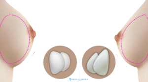 Breast Augmentation in 2025